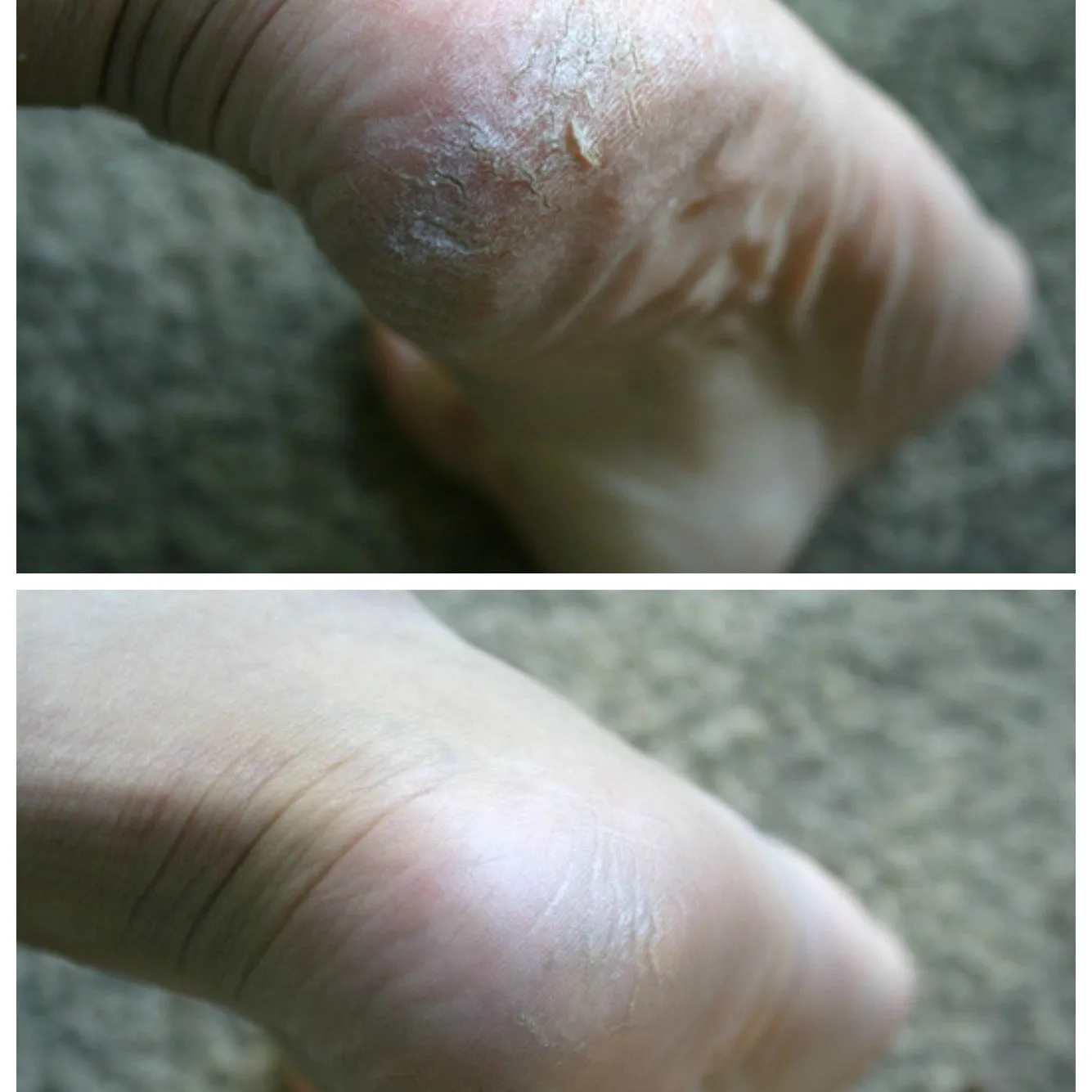 Mini Foot Care Kit